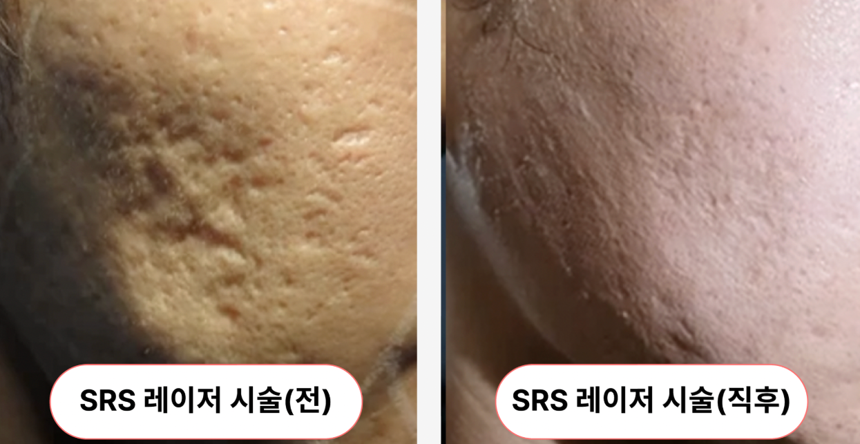 SRS 전 (케이스 1)
