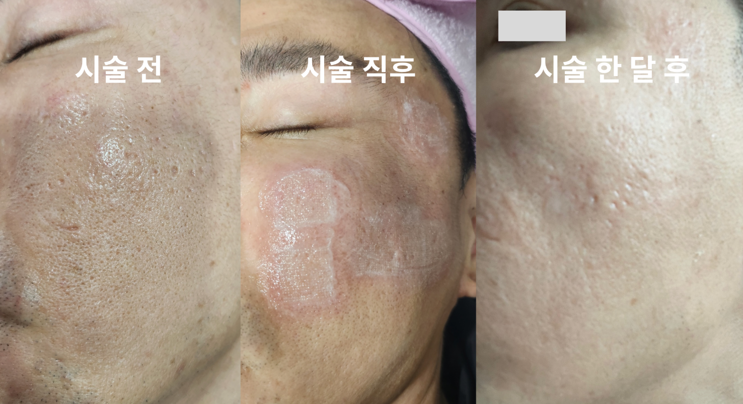 SRS 1개월 후 (케이스 1)