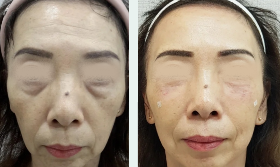 Under-eye filler before/after 3