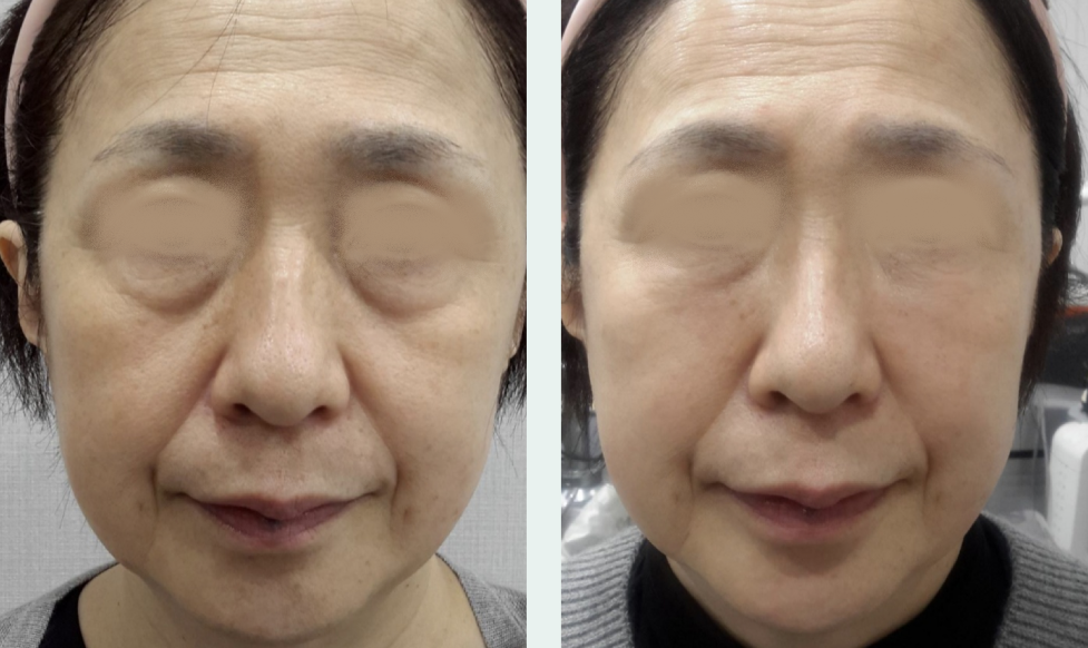 Under-eye filler before/after 1
