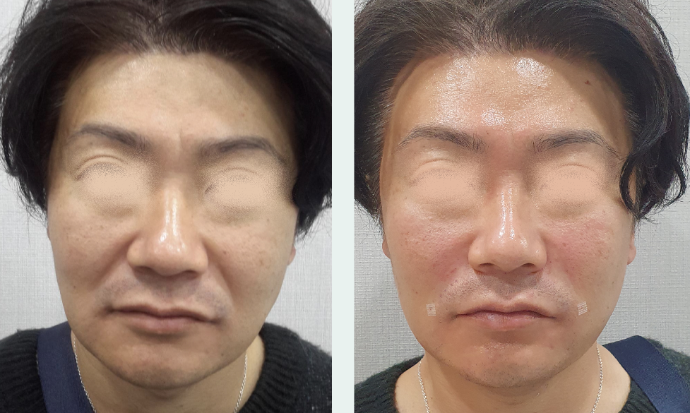 Nasolabial filler before/after 1