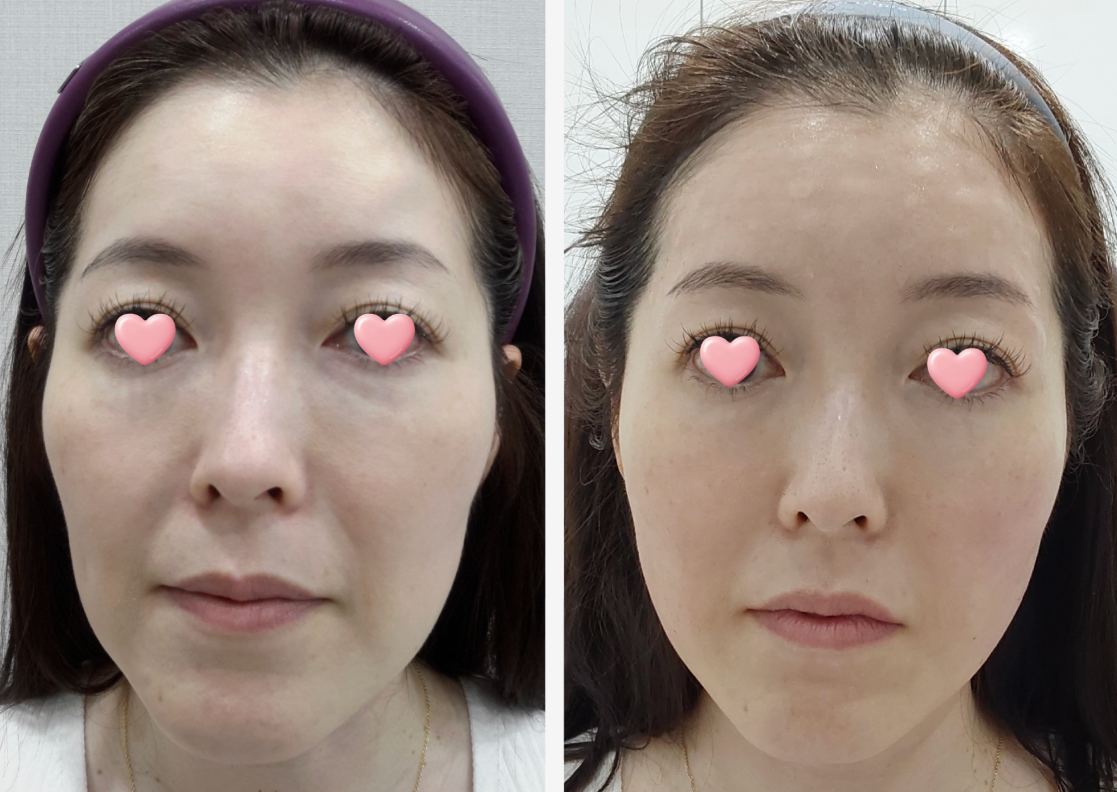 Anterior cheek filler before/after 2