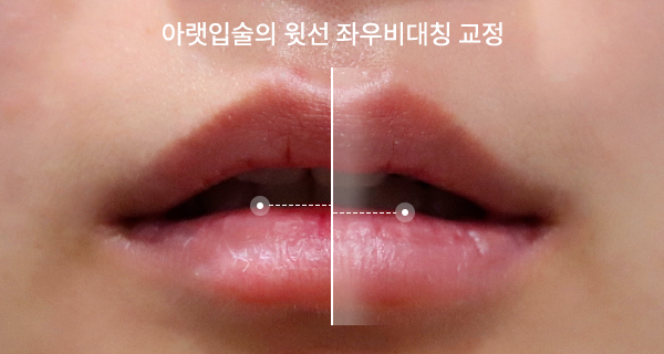 입꼬리필러, 잘하는 병원은 상담부터 다릅니다. : 대구 리프트성형외과ㅣ필러&보톡스ㅣ리프팅ㅣ메디컬스킨케어
