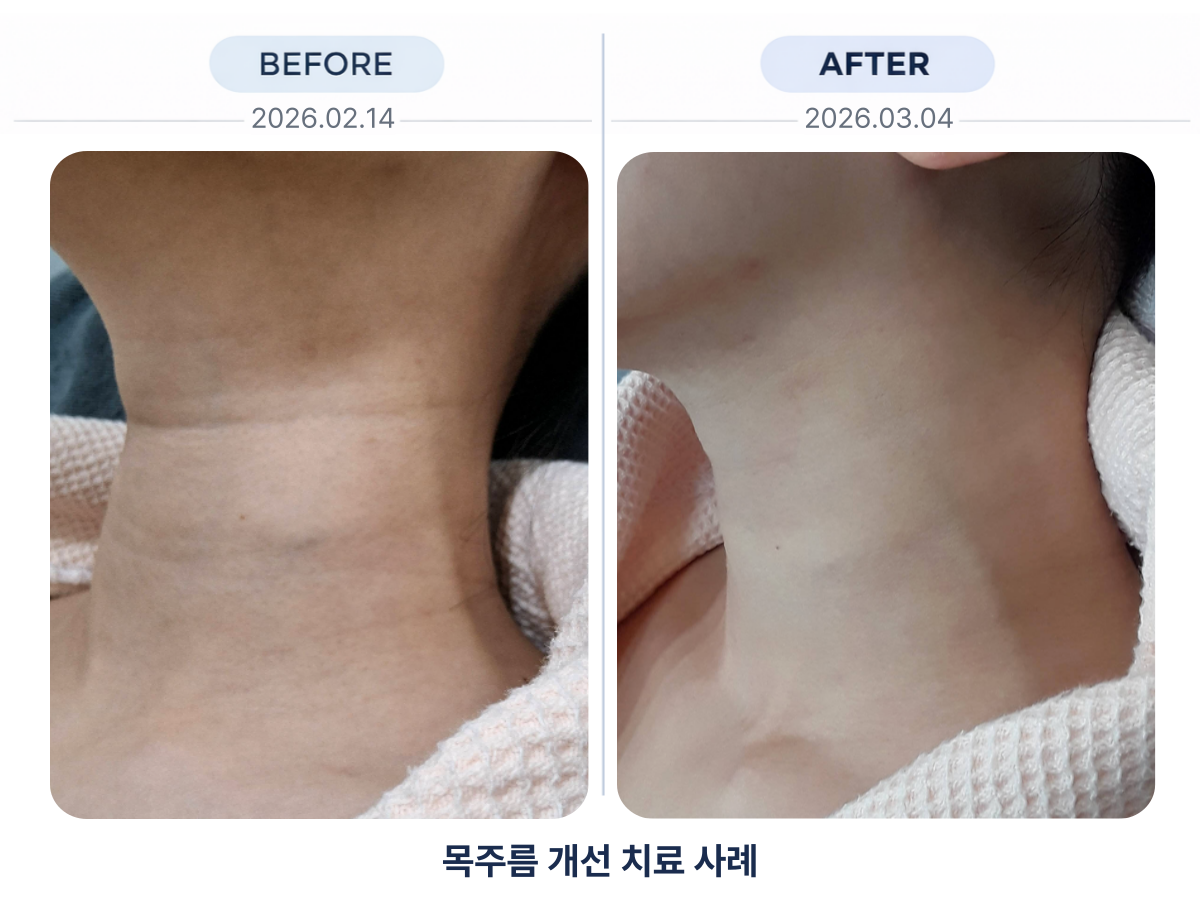 목주름 지우개 시술 전후 결과