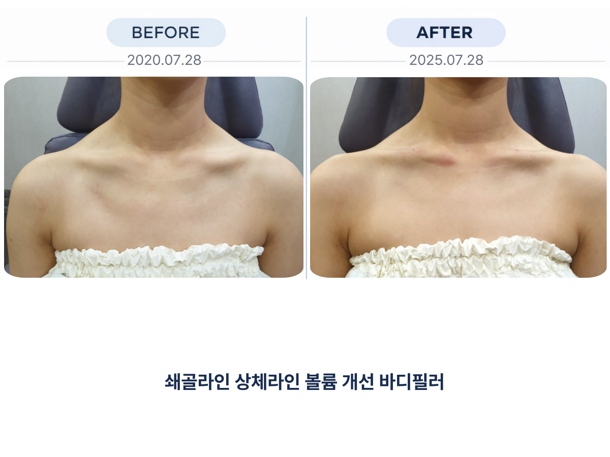 쇄골 필러 전후사진