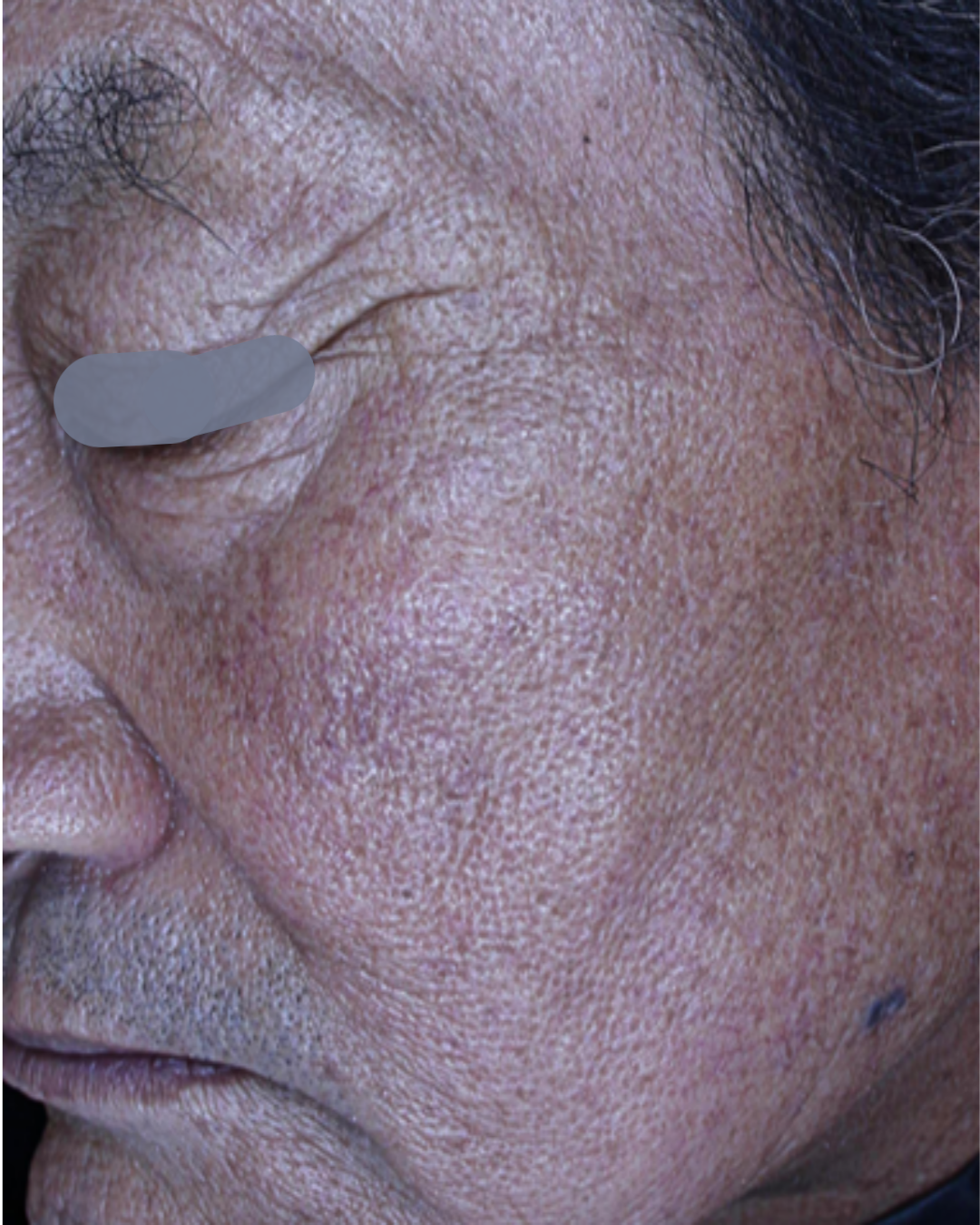 케이스 C 후 사진