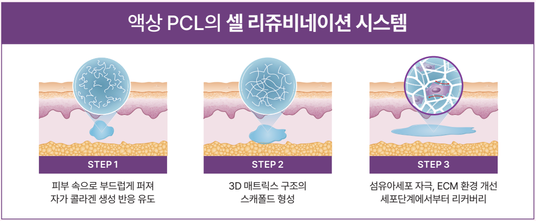 고우리 액상 PCL 시술 원리 다이어그램