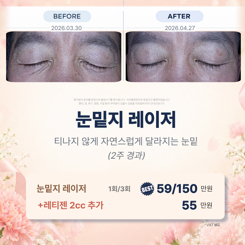 벨루티아이 전후사진