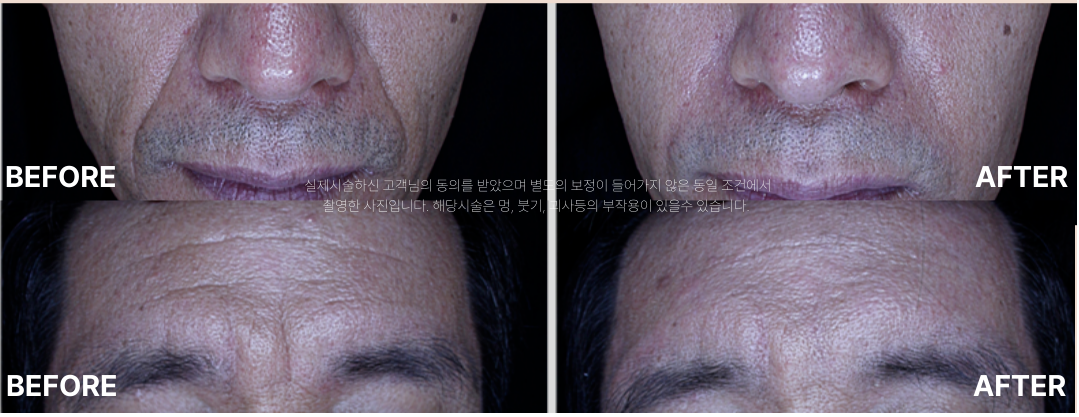 볼륨 안티에이징 필러 스컬트라 시술 전후사진