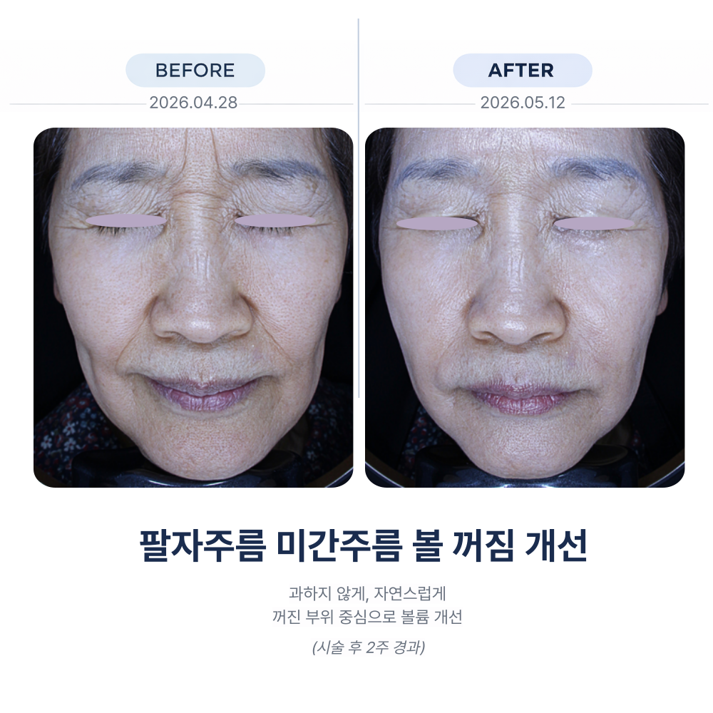 레스틸렌 필러 시술 전후 비교