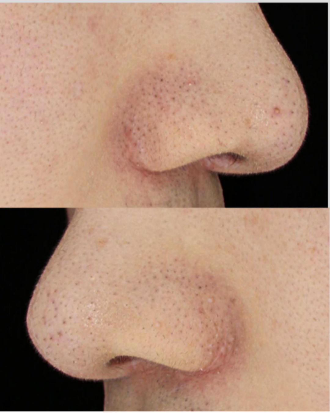 케이스 E 후 사진