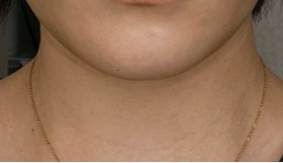 케이스 I후 사진