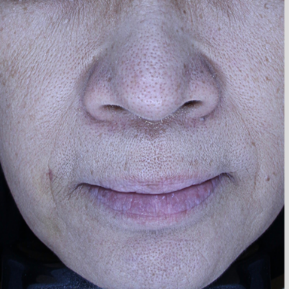 케이스 L 후 사진