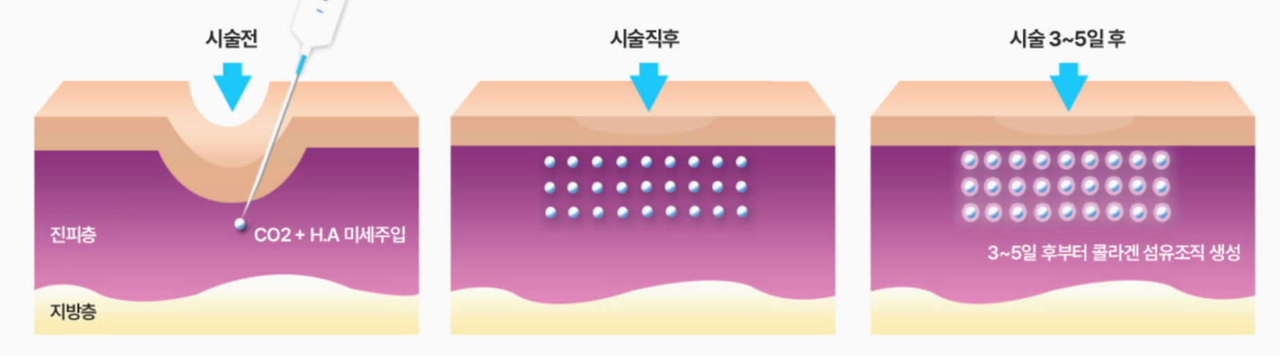 쥬브젠 시술 전후 콜라겐 재생 효과 과정