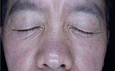 눈밑 지방 다크서클 레이저 시술 전후 - 시술 전