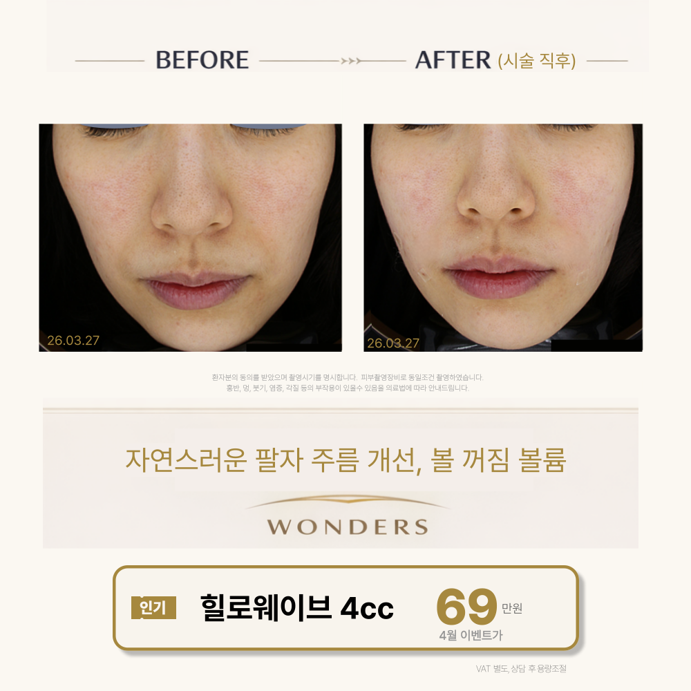 힐로웨이브 전후사진