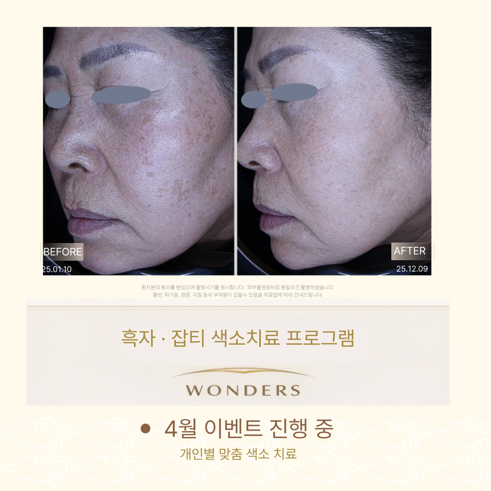 흑자 치료 전후사진