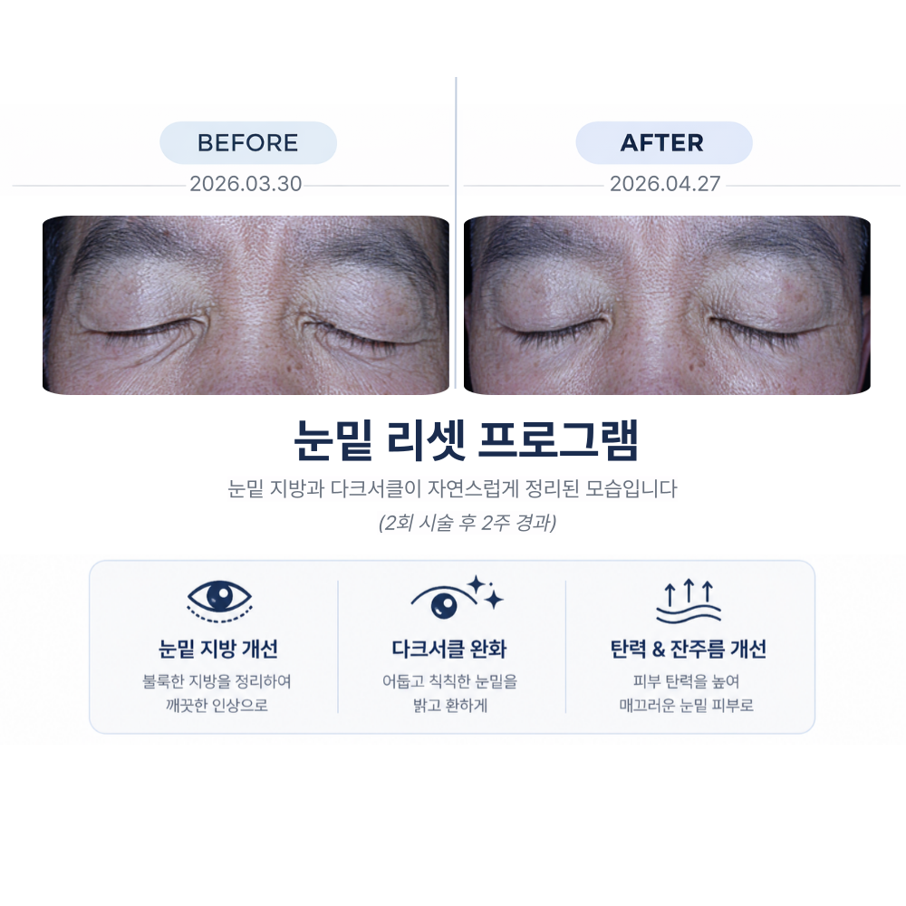 눈밑지방 레이저 2회 시술 전후 비교