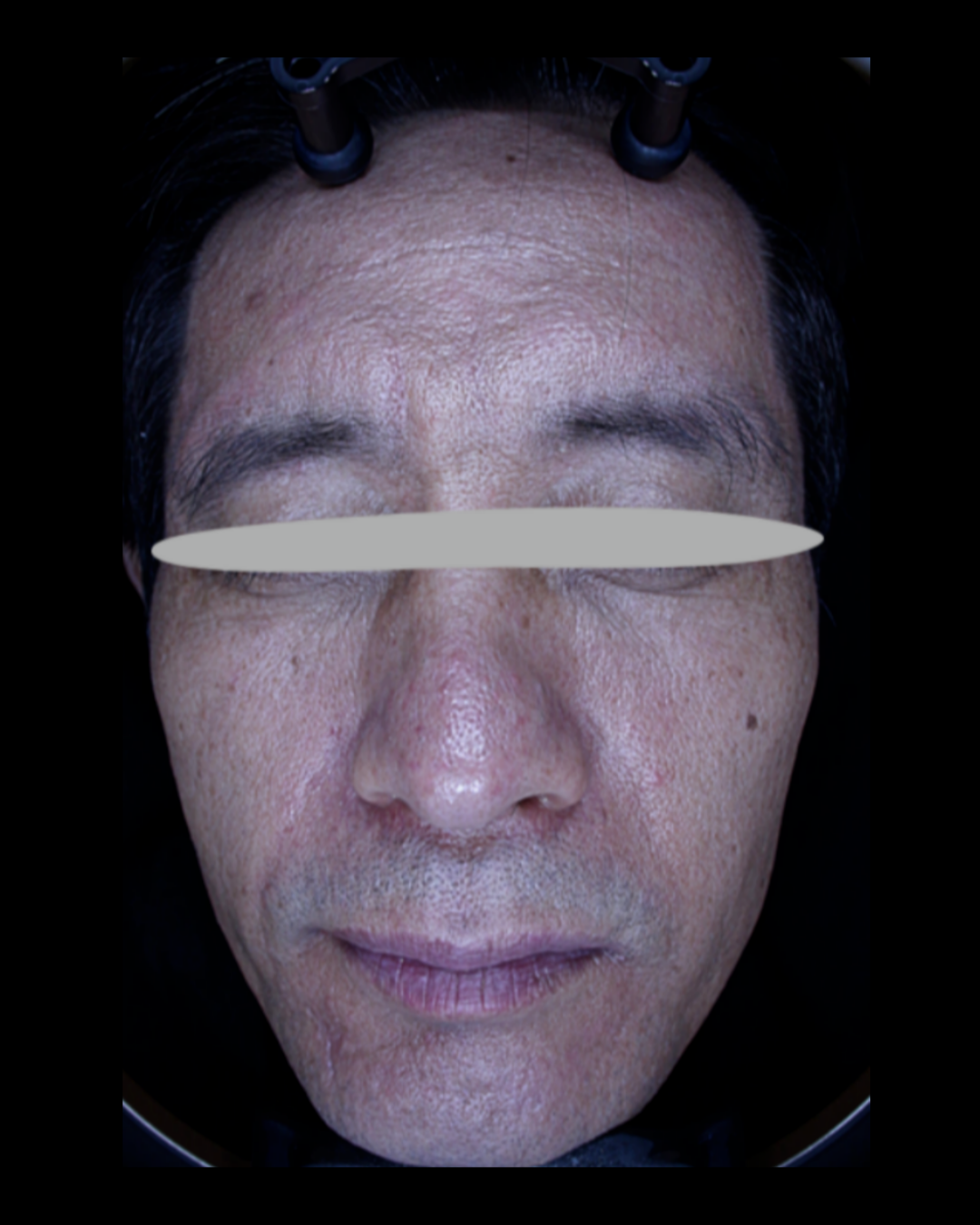 케이스 A 후 사진