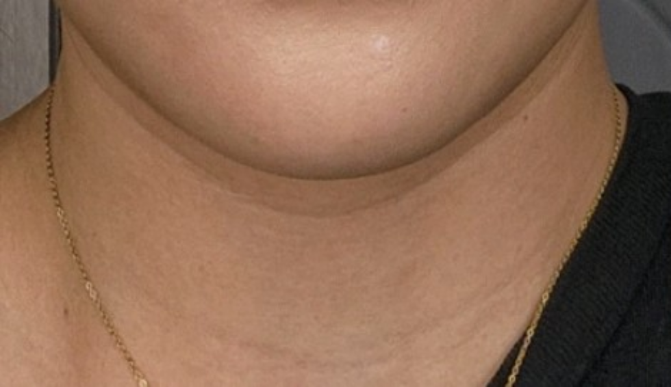 케이스 I 전 사진