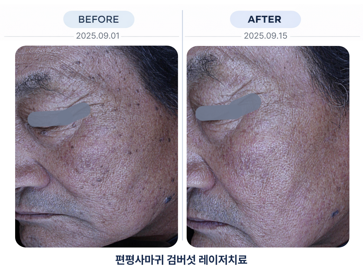 점 편평사마귀 한관종 레이저 제거 시술 전후사진