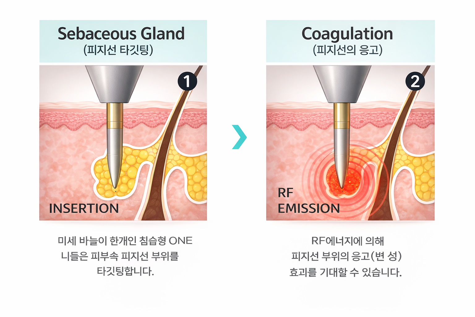 아그네스 치료 원리