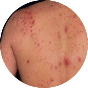 가슴, 등 여드름