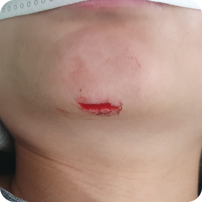 턱 상처 봉합 사례