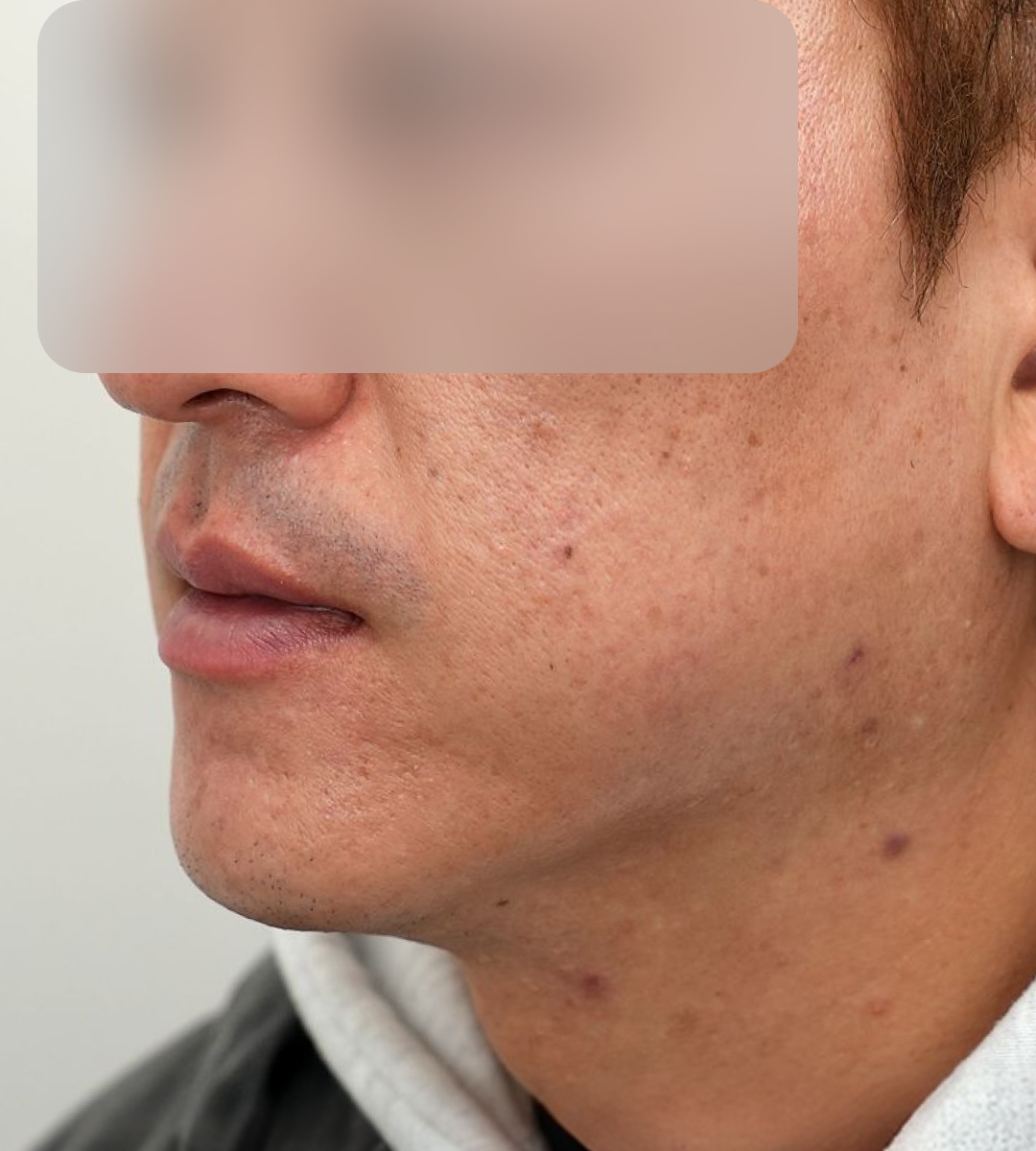 이중턱 지방흡입 실리프팅 예시 2 수술 후