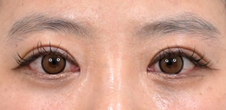 Medial epicanthoplasty case 5 after surgery
