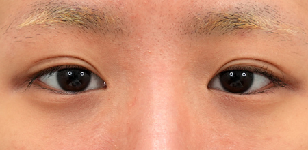 Medial epicanthoplasty case 1 before surgery