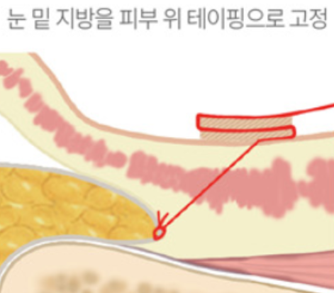 눈밑지방재배치 외부 고정 방식