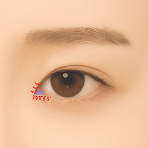 Suture placement after medial epicanthoplasty