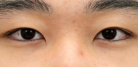 After male non-incisional eyelid surgery