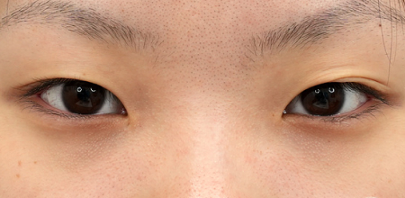 Before non-incisional double eyelid surgery