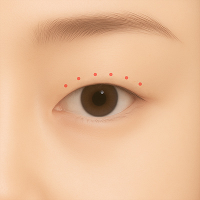 Non-incisional double eyelid surgery illustration