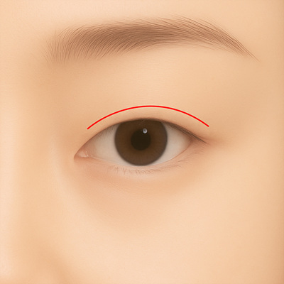 Incisional double eyelid surgery illustration