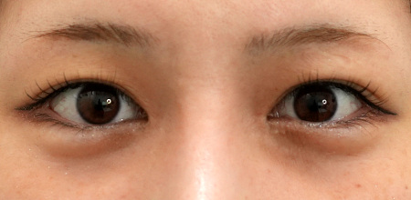 Before incisional double eyelid and ptosis correction