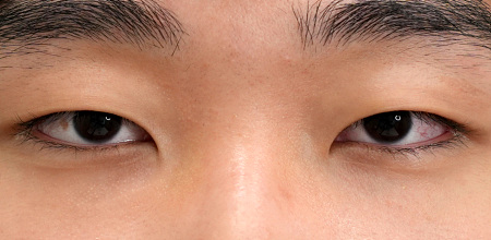 Before male non-incisional eyelid surgery