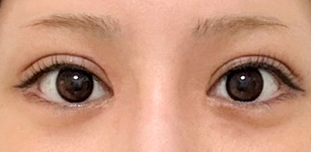 After incisional double eyelid and ptosis correction