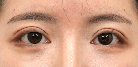 After incisional double eyelid surgery with ptosis correction