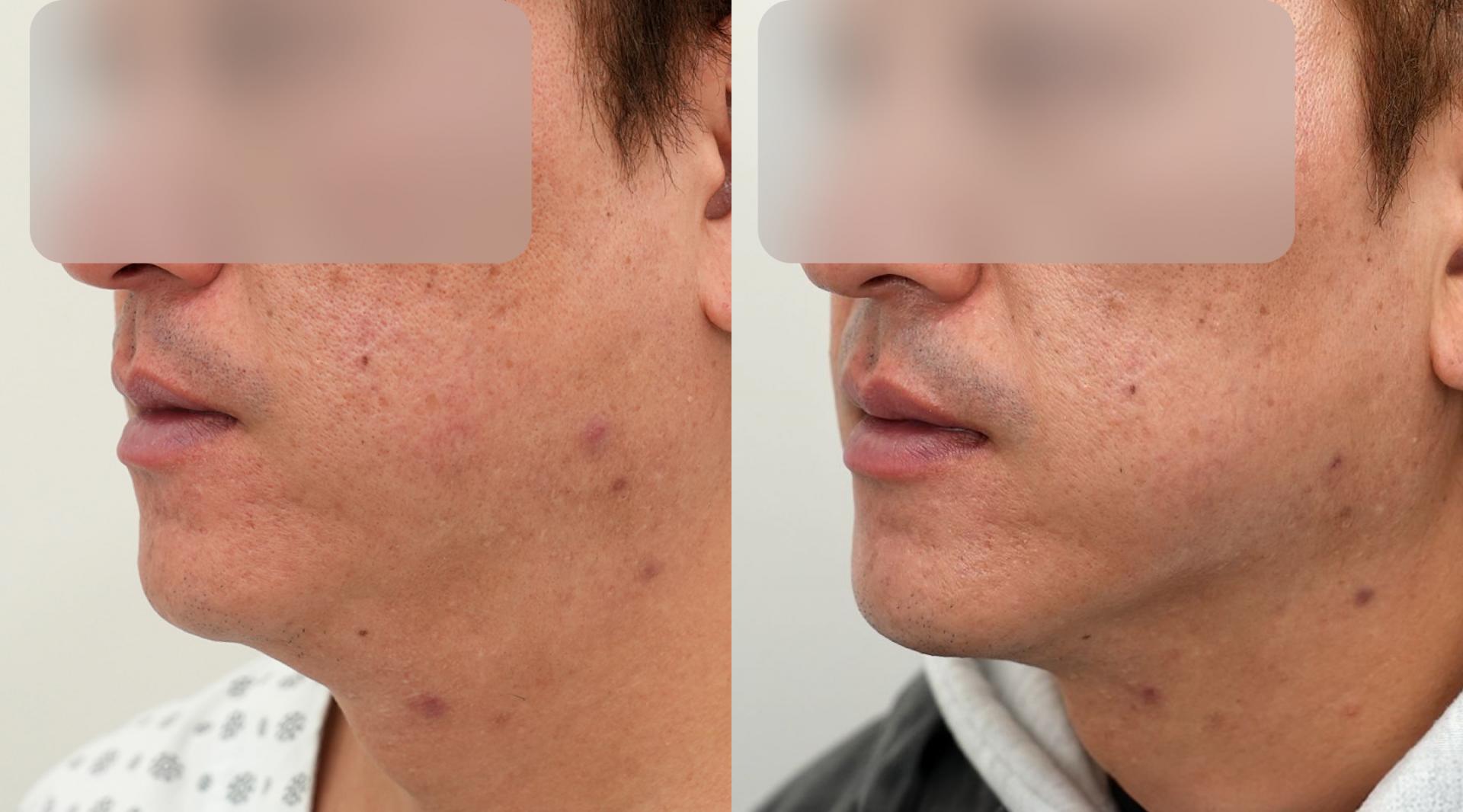 Double chin liposuction and thread lifting before and after — example 1, IK Plastic Surgery