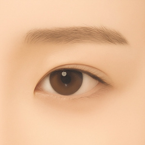 After medial epicanthoplasty