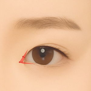Medial epicanthoplasty surgical diagram