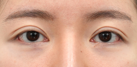 Before incisional double eyelid surgery with ptosis correction