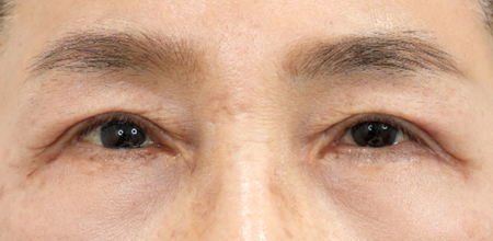 Upper eyelid surgery after