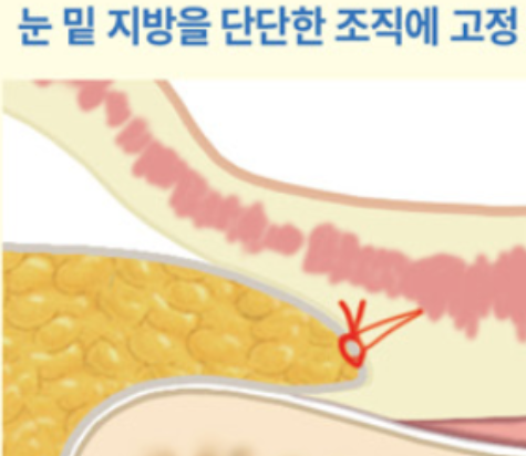 눈밑지방재배치 이지티콘 내부 고정 방식