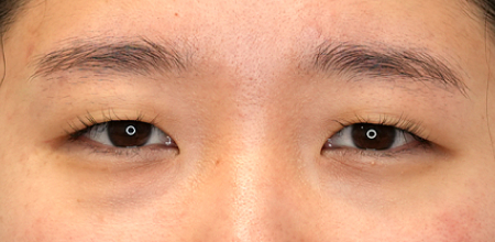 Before incisional eyelid surgery