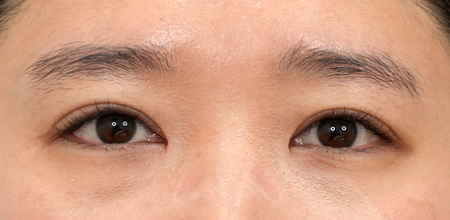 Medial epicanthoplasty case 4 after surgery
