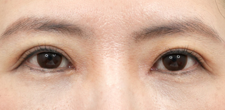 under-eye fat repositioning case 3 after